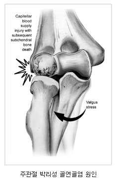 주관절 박리성 골연골염 원인