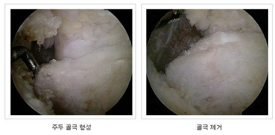 주두 골극 형성/골극 제거