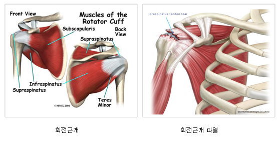 회전근개파열 및 관절 내시경 봉합후 사진