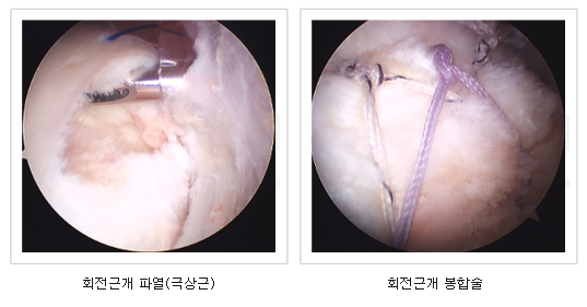 관절내시경