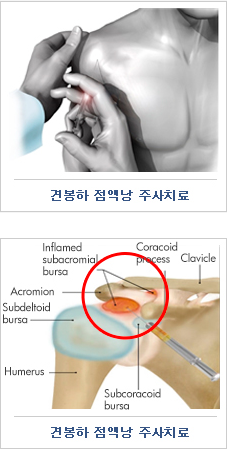 견봉하 점액낭 주사치료