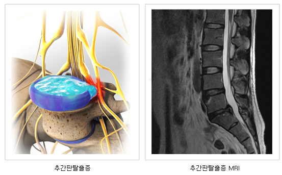 추간판탈출증/추간판탈출증 MRI