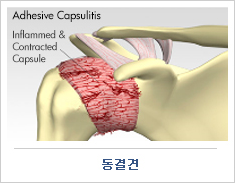 견봉하 점액낭 주사치료