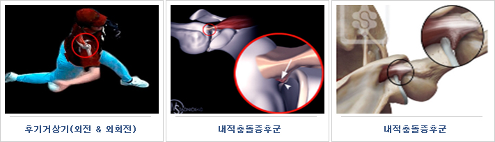 내적충돌증후군 사진