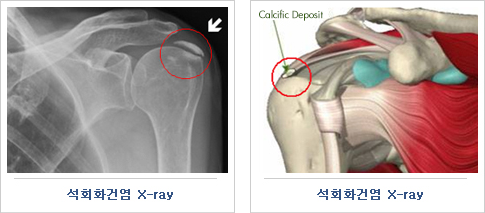 석회화건염 x-ray 사진