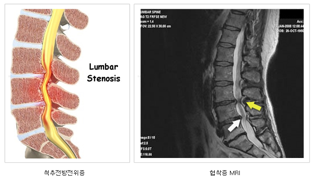 척추관 협착증/협착증 MRI